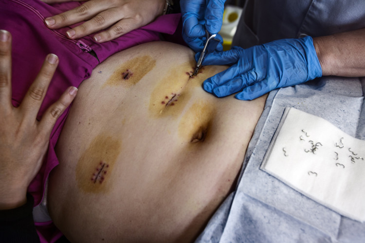 Barcelona, Spain - May 2012 One week after surgery, to Sandra are removed the staples. Only five small holes through which the surgeons passed with laparoscopic to remove part of the intestine and reduce the stomach. Barcellona, Spagna - Maggio 2012 A una settimana dall'intervento a Sandra le vengono rimosse le graffette. Solo cinque piccoli buchi attraverso i quali i chirurghi sono passati con laparoscopica per rimuovere una parte di intestino e ridurre lo stomaco.