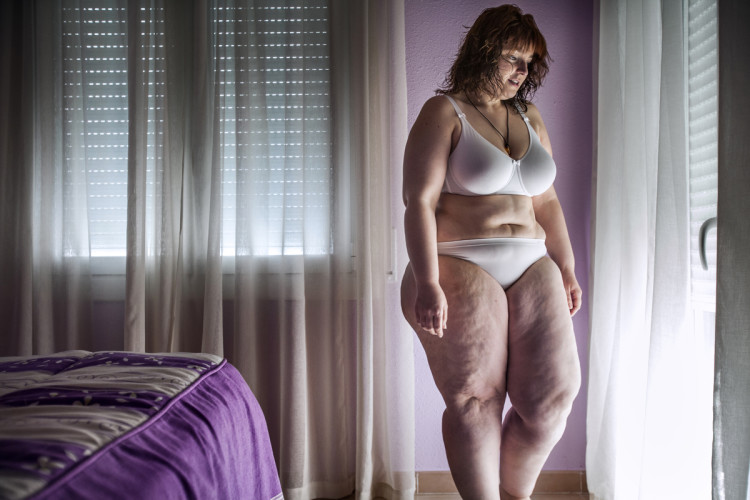 Barcelona, Spain - April 2012 Sandra in her room while dressing up to go to the doctor. At this stage Sandra was a bit less than 120 kg and it was when she started the program to be admitted at the gastric bypass surgery. Barcellona, Spagna - Aprile 2012 Sandra in camera sua mentre si accinge a vestirsi per andare dal medico. In questa fase Sandra era un po 'meno di 120 kg ed è stato quando ha iniziato il programma di ammissione alla chirurgia di bypass gastrico.